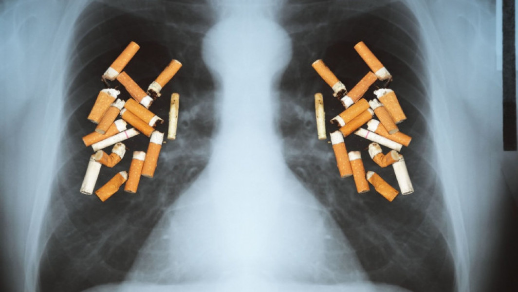 Medicul pneumolog Cristian Oancea avertizează asupra riscurilor cancerului bronho-pulmonar