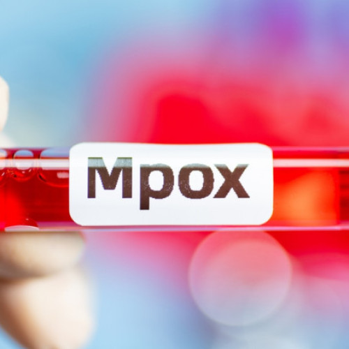 Anglia raportează un nou caz de infectare cu varianta Mpox, clada lb