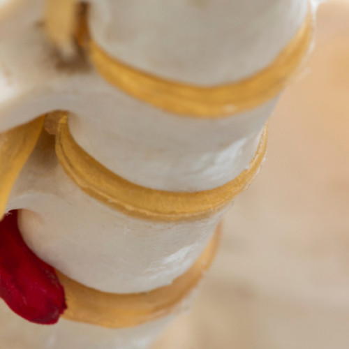 Hernia de disc poate remodela viața dacă nu este tratată la timp